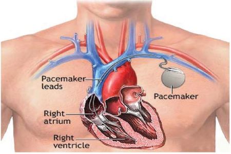 Pacemaker Implantation In Pune